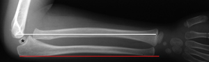 Figure 2_Monteggia type 1_plastic deformation.jpg